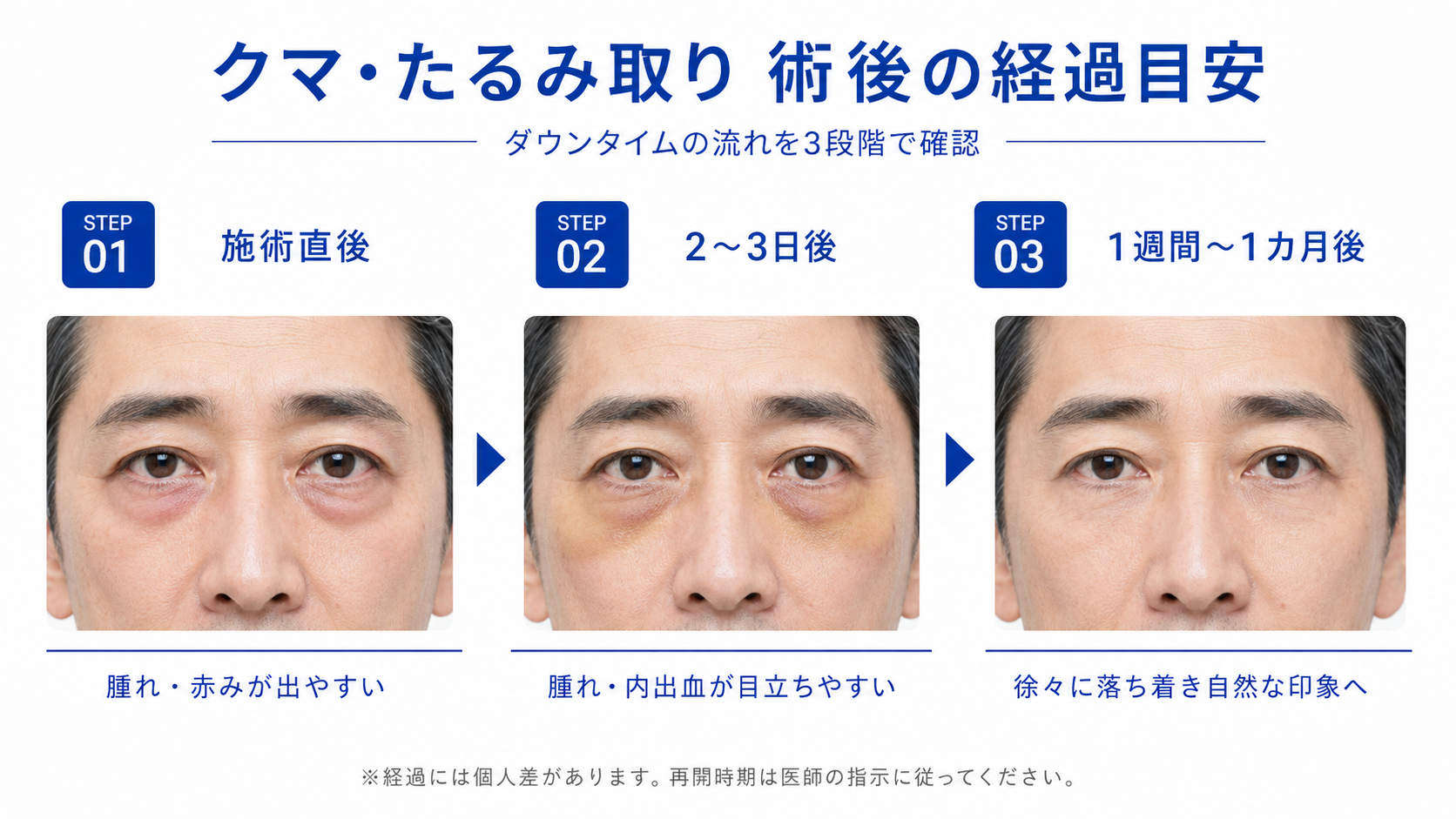 クマ・たるみ取りの術後経過の目安(3段階)