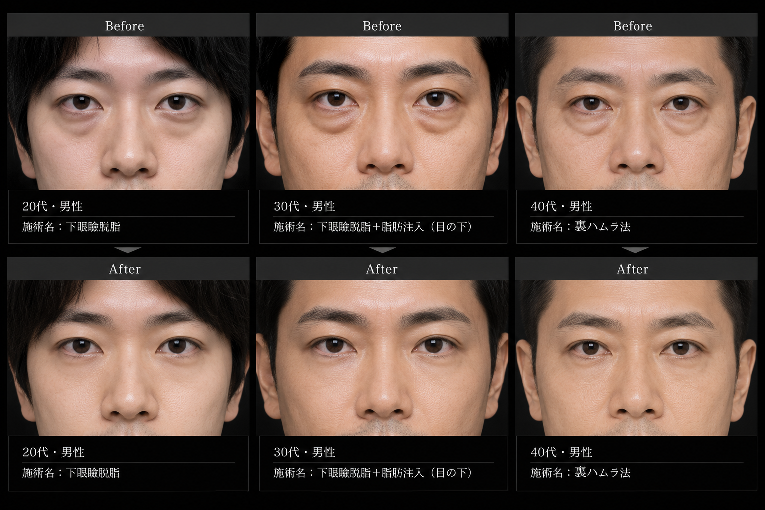 TAクリニックのクマ取り症例(男性ビフォーアフター)