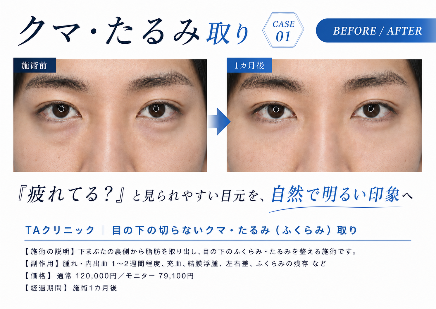 クマ・たるみ取りの症例写真(CASE01・ビフォーアフター)