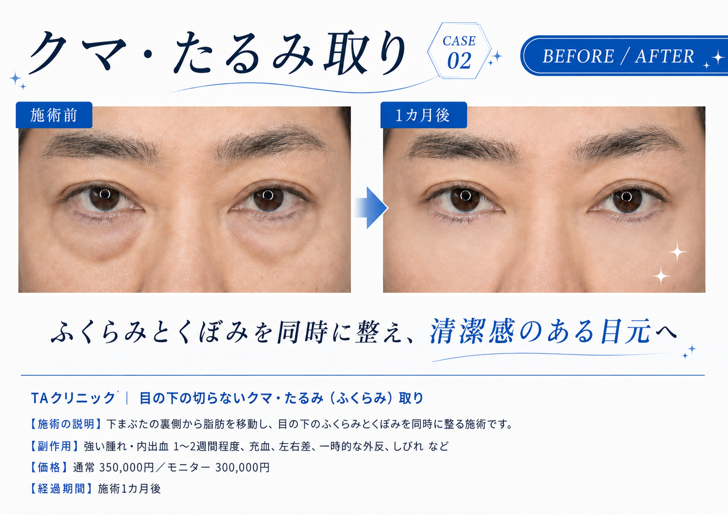 クマ・たるみ取りの症例写真(CASE02・ビフォーアフター)